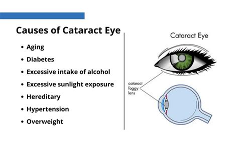 What Is The Main Cause Of Cataract